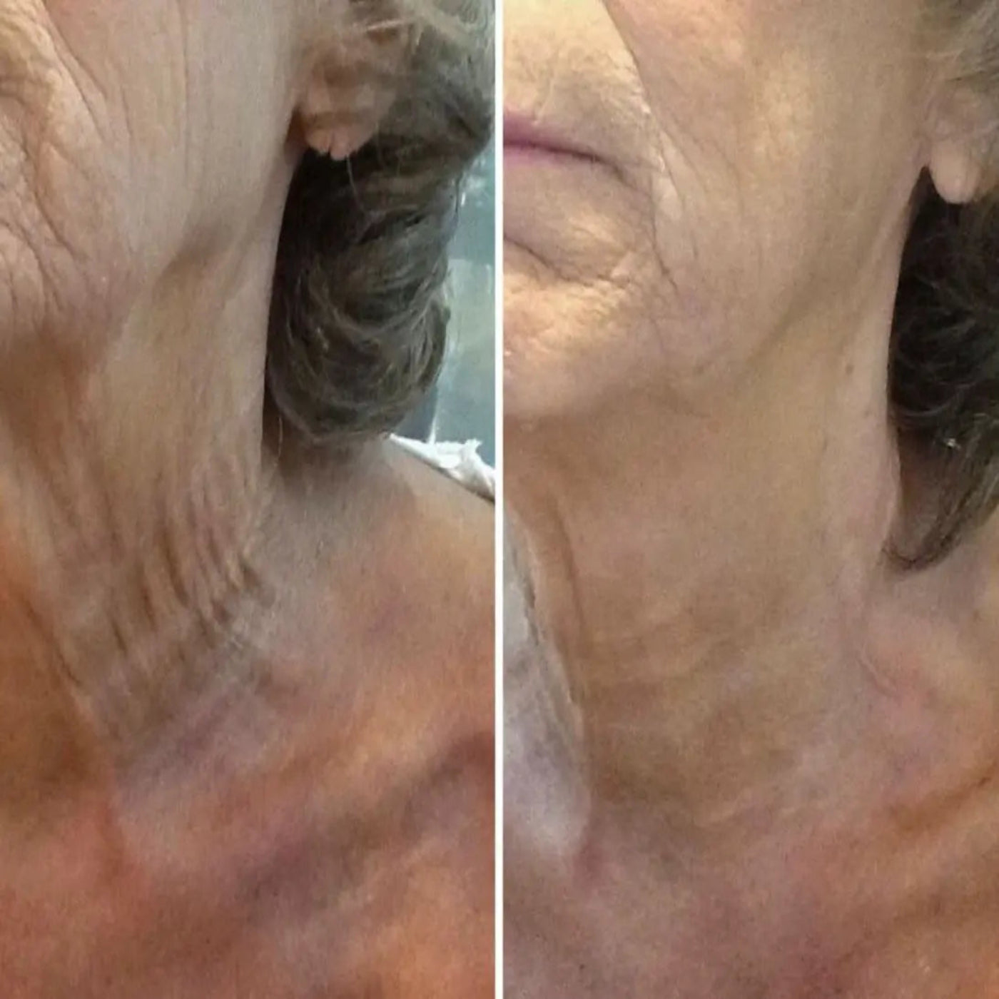 Ageless Glow Kit - Microneedle Serum Refill System Hypersku