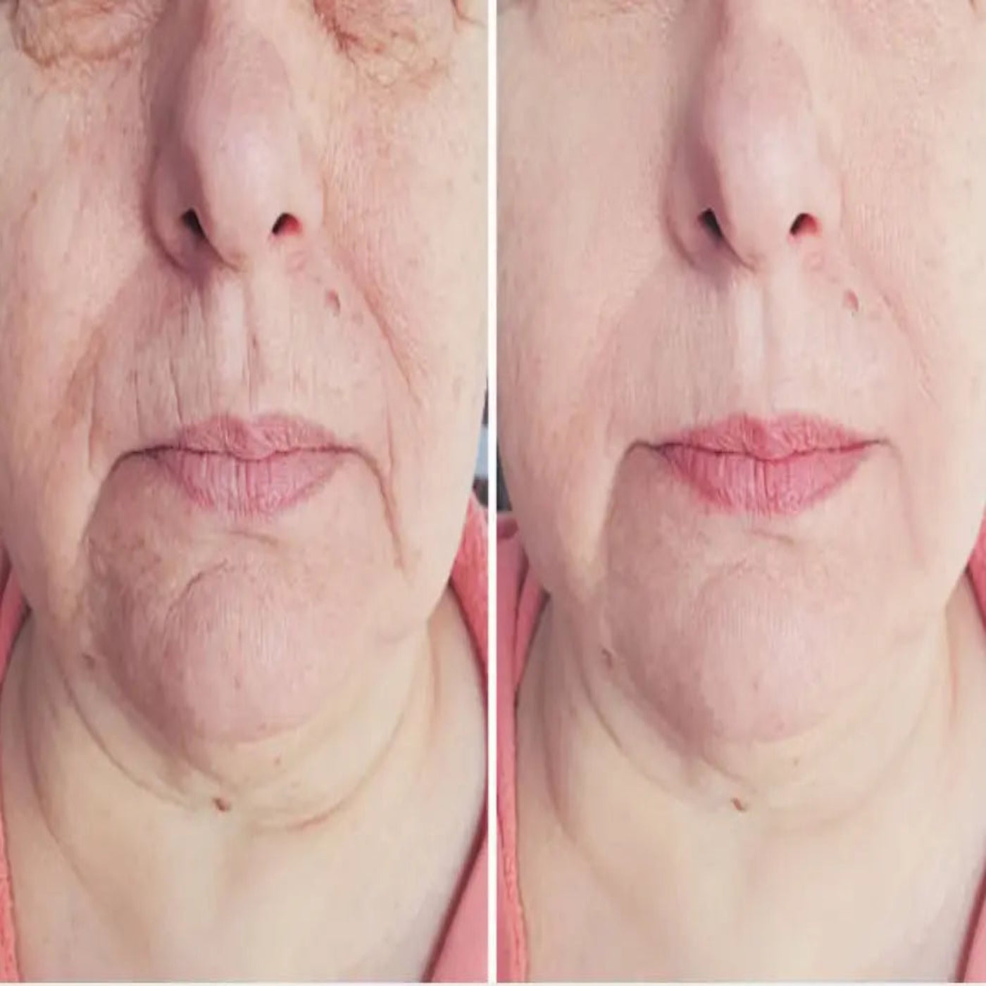 Ageless Glow Kit - Microneedle Serum Refill System Hypersku